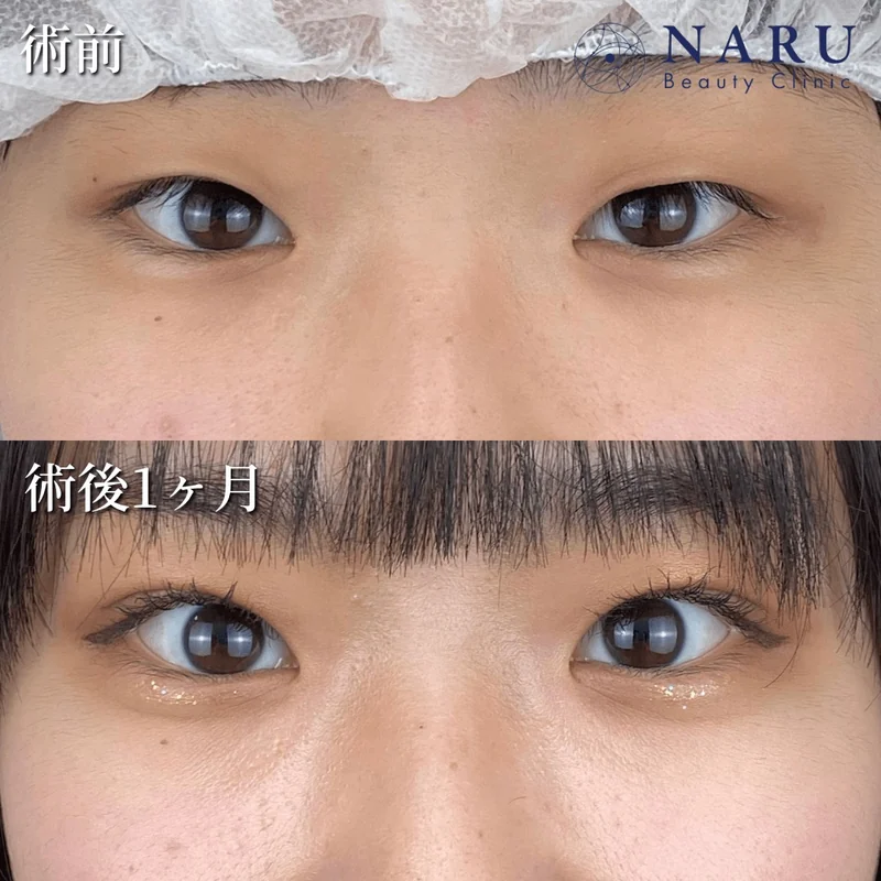 公式の症例。ナルクリ二重術