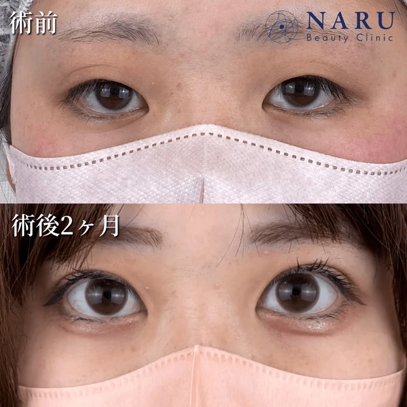 公式の症例。ナルクリ二重術
