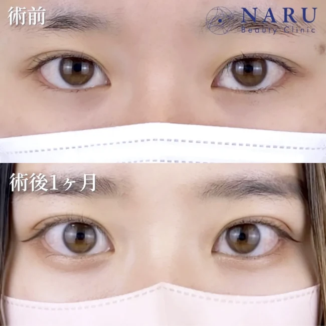 公式サイトの症例。ナルクリ二重術