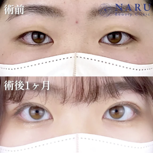 公式サイトの症例。ナルクリ二重術